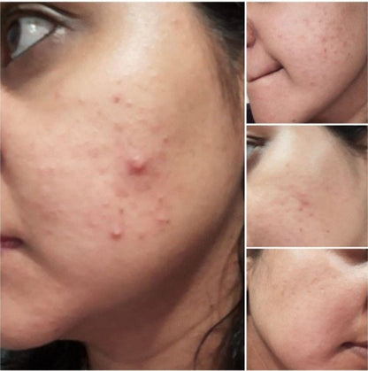 Acne Spotless Serum: Targeted Anti-Acne Solution for Clear, Spotless Skin